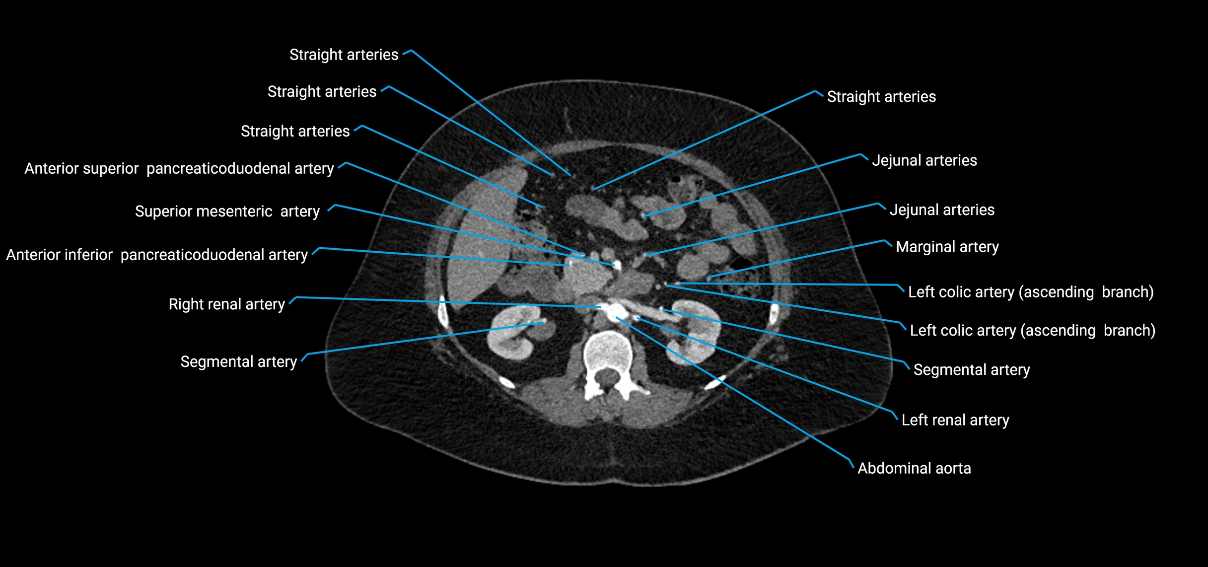 CTA abdomen axial cross sectional anatomy labelled image_75 (2).webp